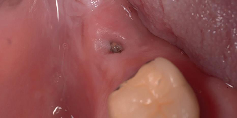 Sobrecrecimiento de tejido gingival sobre la plataforma del implante.