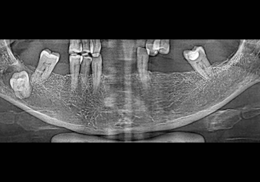 Initial x-ray image of the absent teeth 