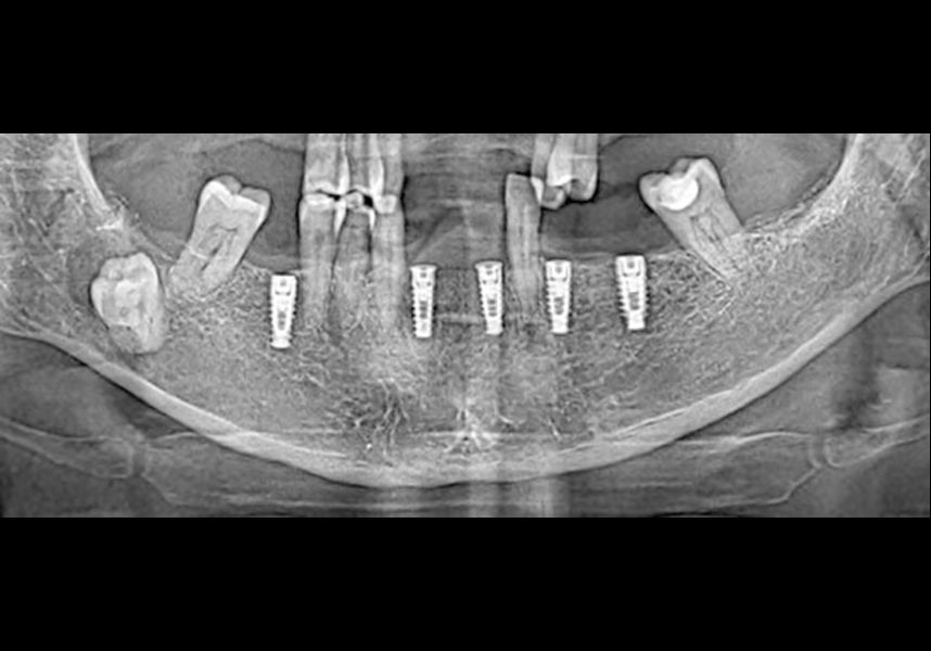 X-ray image after implant placement.