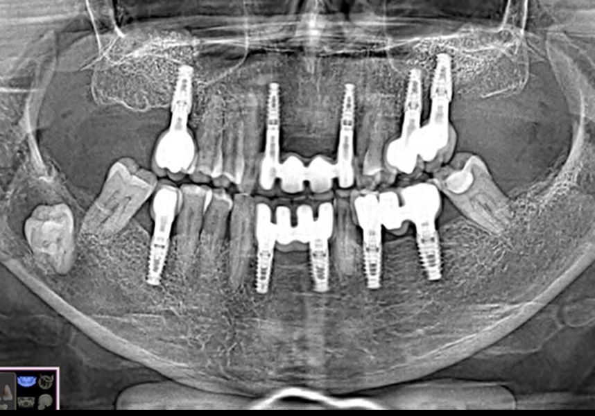 X-ray review one year after implant placement and bone regeneration