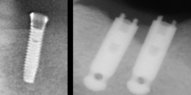 Imágenes radiográficas de implantes con fragmentos de tornillos en su interior