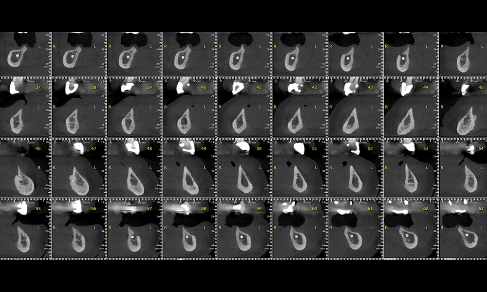 Imágenes radiográficas de la poca disponibilidad de hueso mandibular
