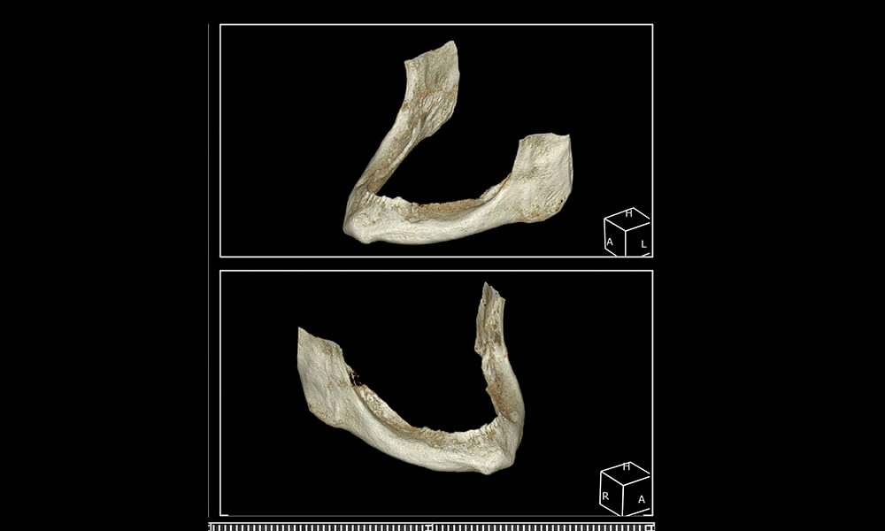 Imágenes radiográficas de la poca disponibilidad de hueso mandibular