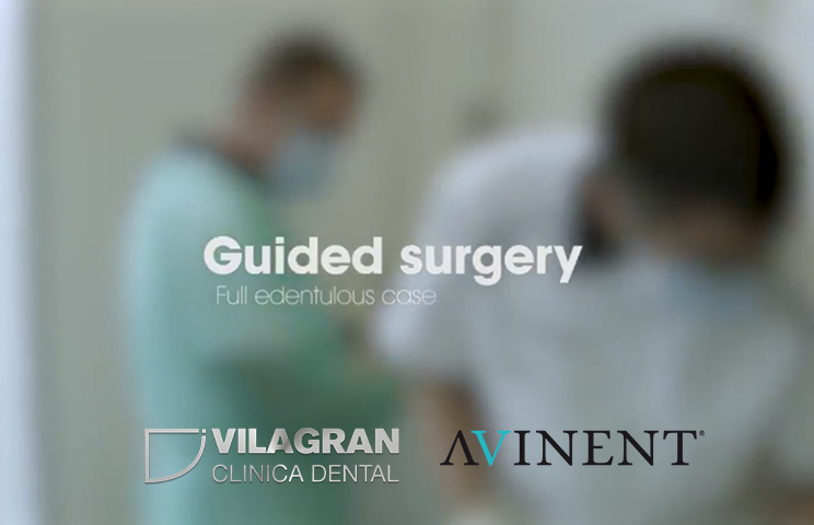Guided surgery – case of a fully edentulous patient