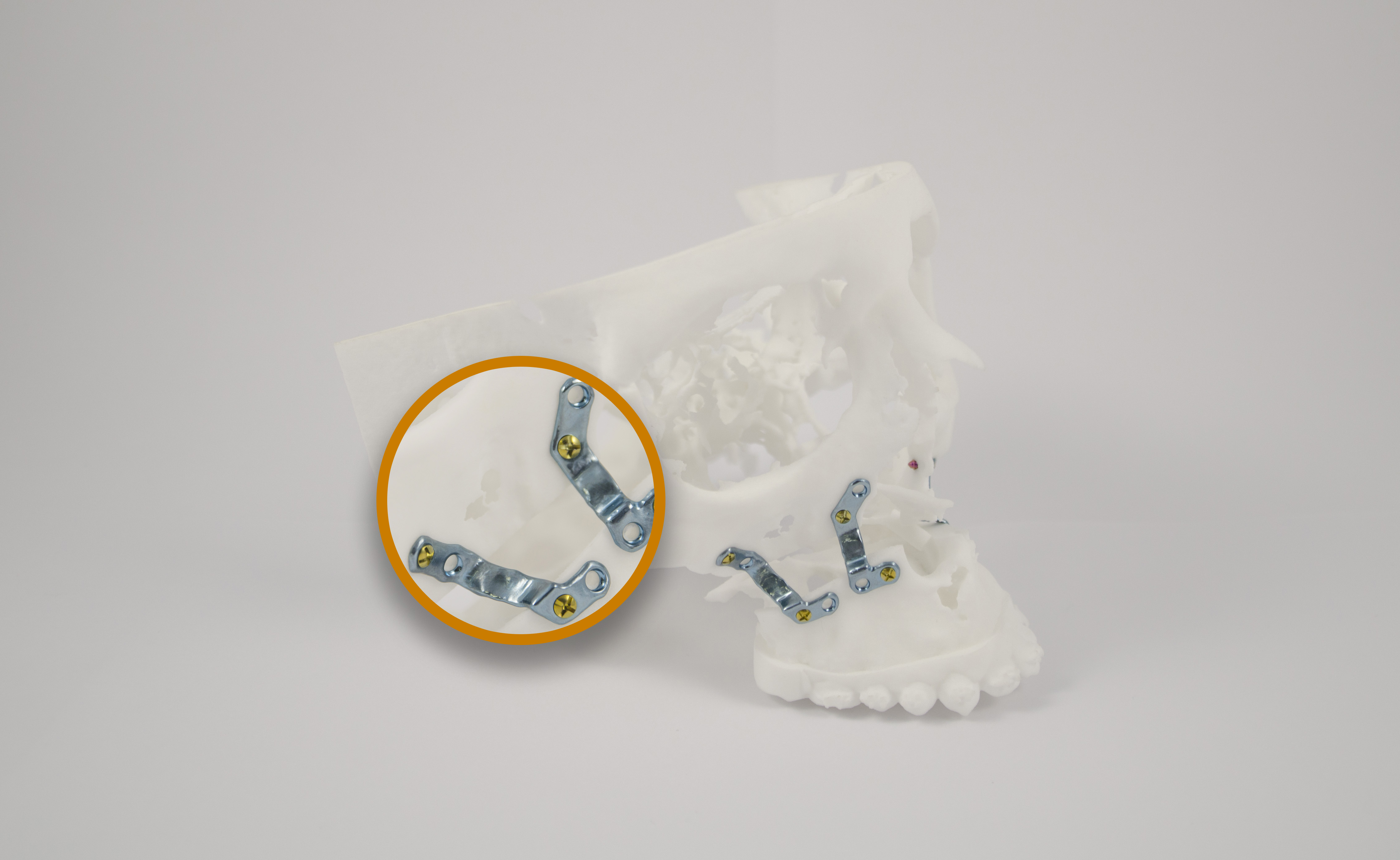La impresión 3D revoluciona la cirugía ortognática – Parte 1