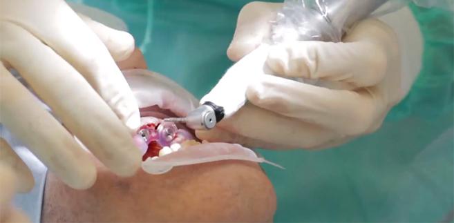 VIDEO: The many advantages of the new guided-surgery system developed by 3Shape in collaboration with Avinent-Core3dcentres