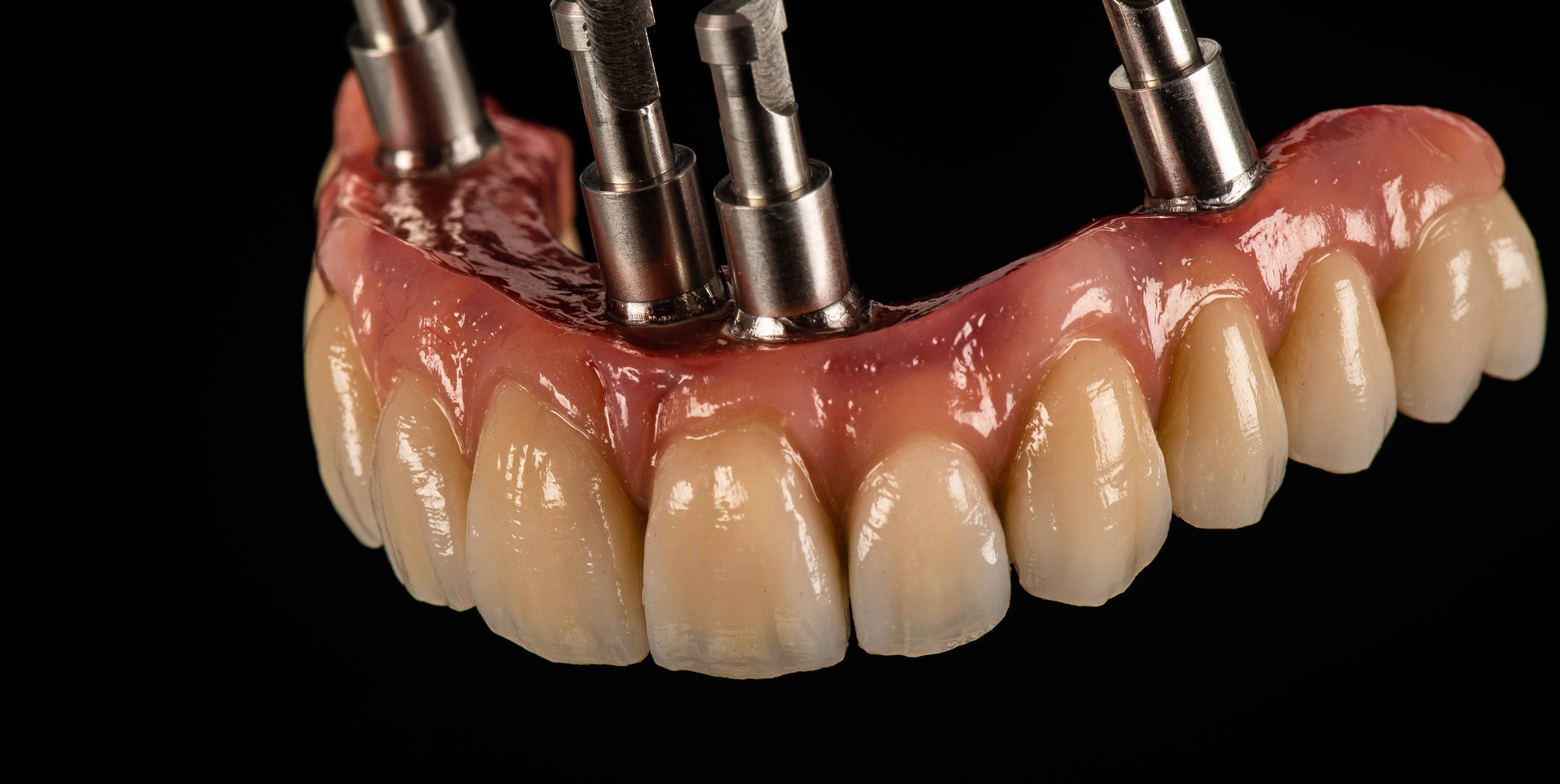Jorge Reyes, técnico dental: “Las AURORA facilitan una mayor unión y retención de material entre el composite y la estructura”