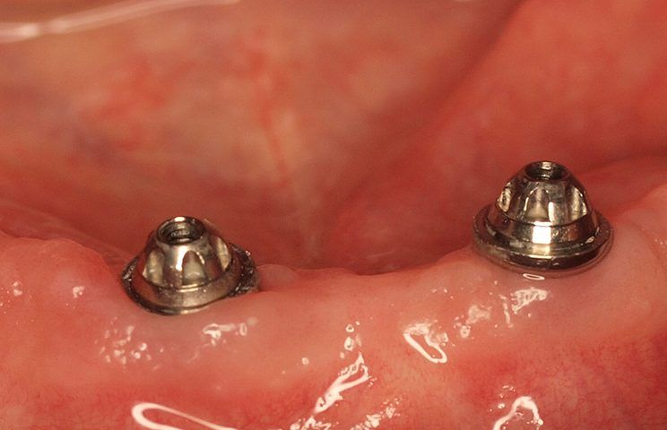 Restoration of upper and lower jaws with CAD-CAM milled structure - AVINENT