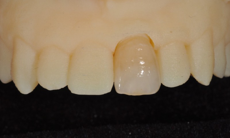 How can we improve dental color-matching in digital restorations?