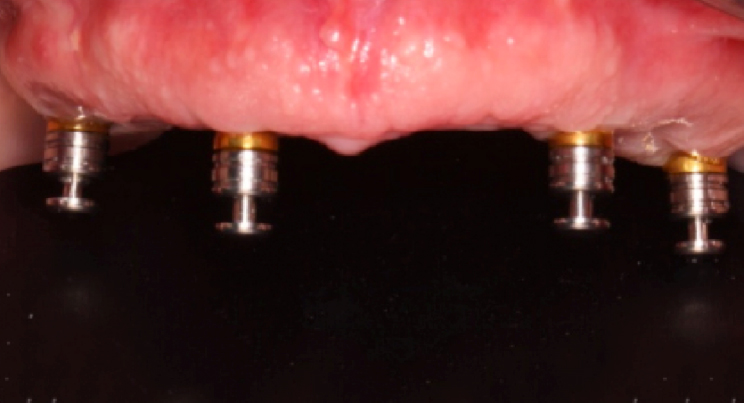 Rehabilitación del maxilar edéntulo con una sobredentadura retenida sobre 4 implantes mediante ataches de precisión tipo RHEIN’83®: a propósito de un caso.