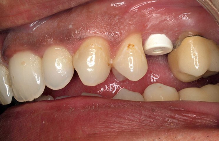 Post-Extraction BIOMIMETIC OCEAN CC implant with PEEK healing abutment