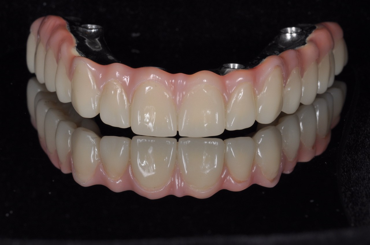 Full implant-supported restoration using AURORA system