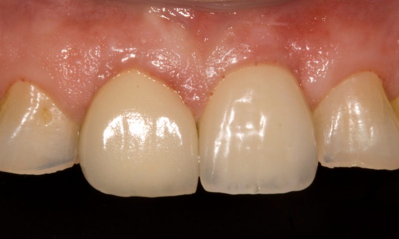 Immediate post-extraction Biomimetic Coral IC implant placement in the anterior esthetic zone