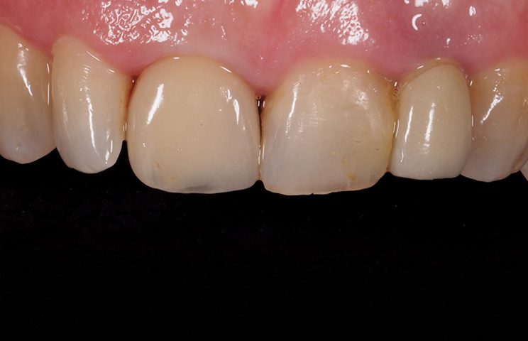 Creating emergence profiles in immediate implant dentistry