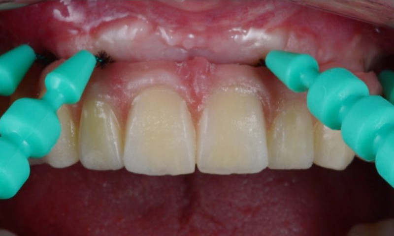 Maintenance of dental implants