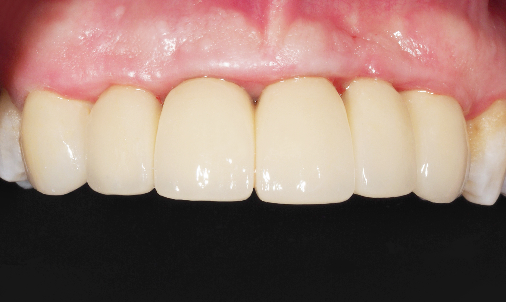 Immediate loading of the anterior sector – From provisional to final restoration