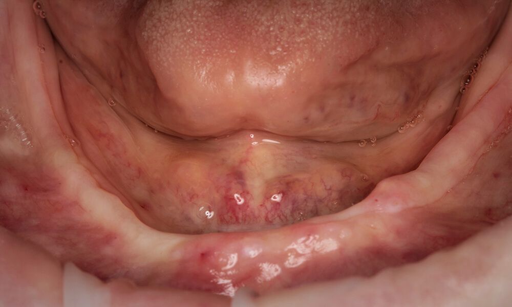 Initial status of the case of severe mandibular bone loss
