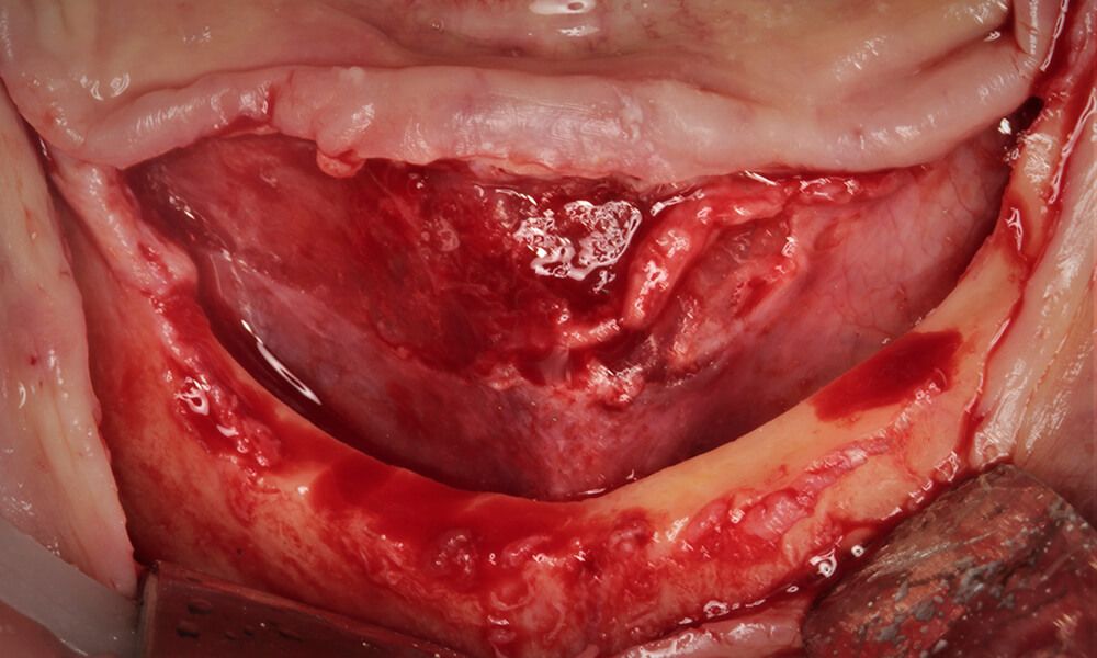 Preparation of the bone crest