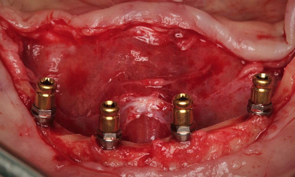 Placement of the Pearl mini-implants