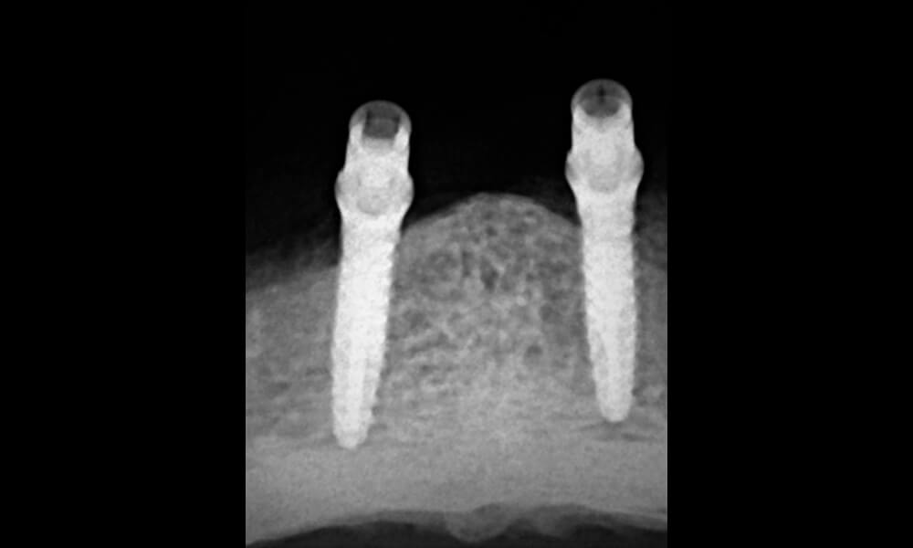 X-ray of mini-implants in place