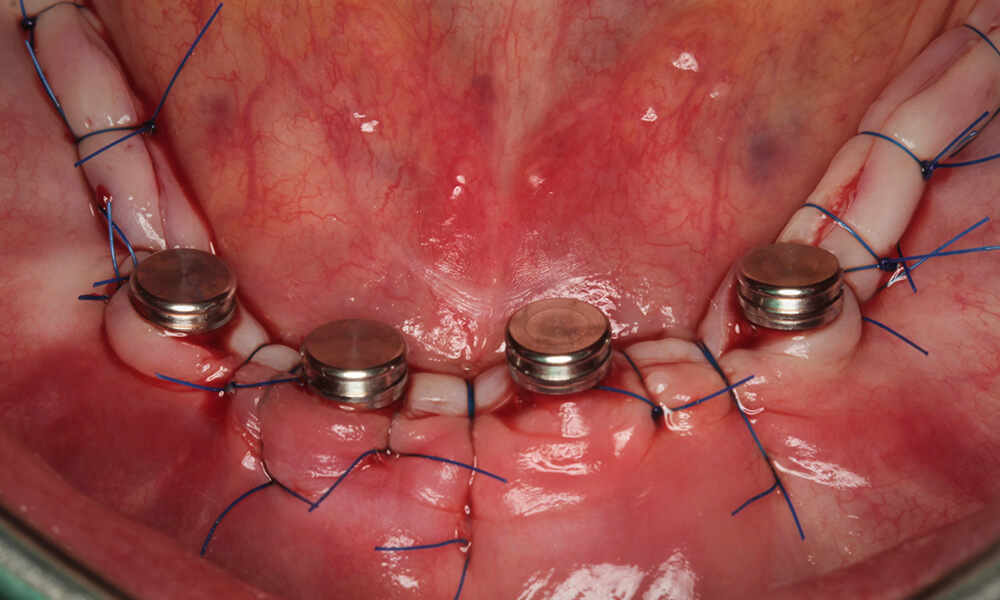 Intraosseous suture and adaptation of the tissue to the caps